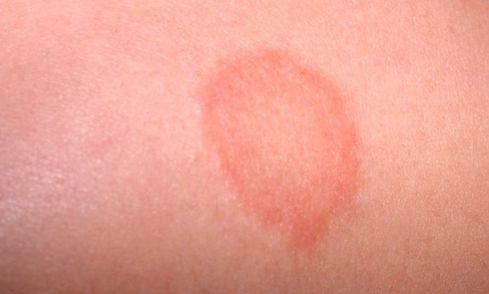 home-remedies-for-ringworms-know-before-you-go